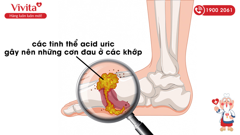 bệnh gout là gì