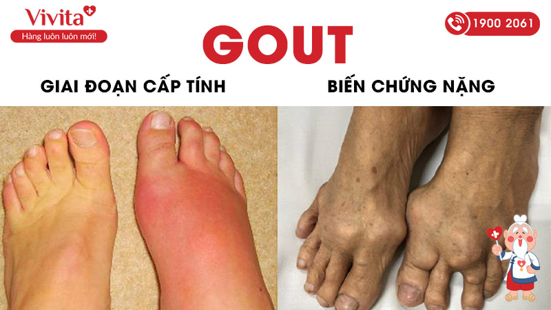 các giai đoạn của bệnh gút