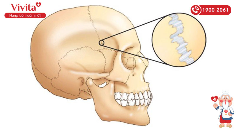 khớp bất động