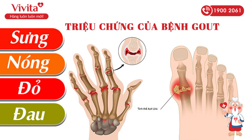 triệu chứng của bệnh gút