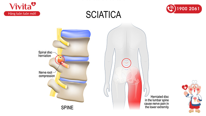 Bệnh đau thần kinh tọa có tên tiếng anh là sciatica