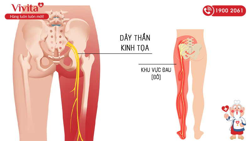 Bệnh đau thần kinh tọa là một bệnh lý xương khớp trong đó tình trạng đau thắt lưng xuất hiện thường xuyên