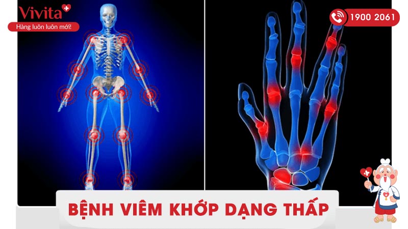 bệnh viêm khớp dạng thấp là gì