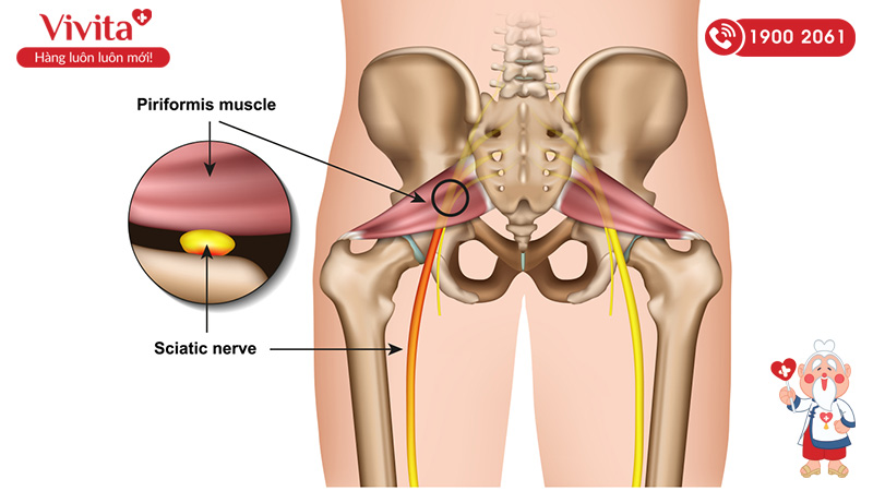 Nguyên nhân của bệnh đau dây thần kinh tọa là do chèn ép dây thần kinh