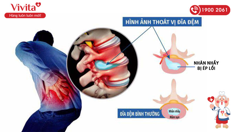 Nhân nhầy này bị ép lồi, lệch ra khỏi vị trí bình thường gây chèn ép lên tủy sống