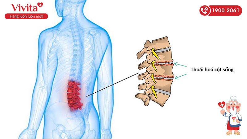 Thoái hóa cột sống là bệnh xương khớp xuất hiện do sự tổn thương sụn khớp bởi các tác nhân ngoại cảnh