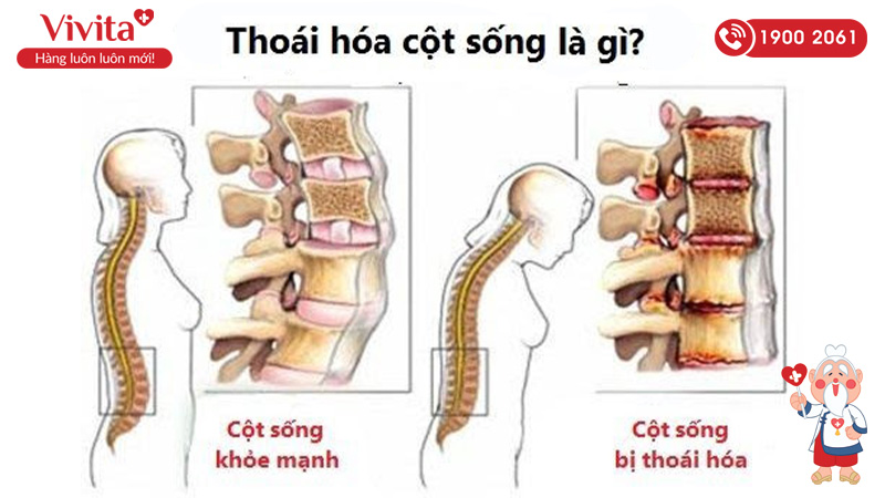 thoái hóa cột sống là gì