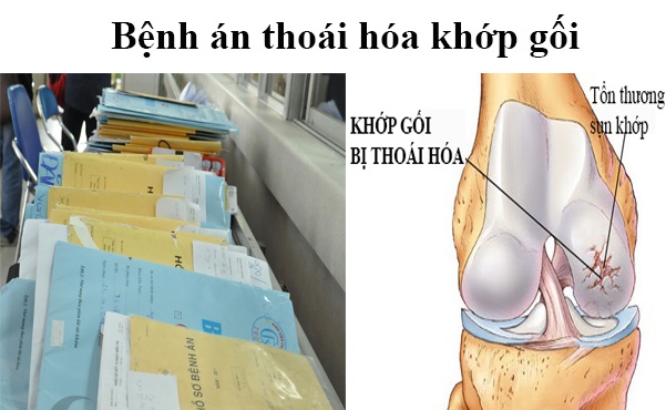 benh-an-dong-y-thoai-hoa-khop-goi