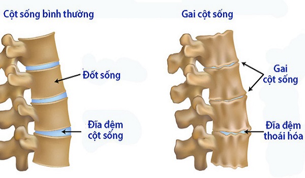 benh gai cot song nen uong thuoc gi