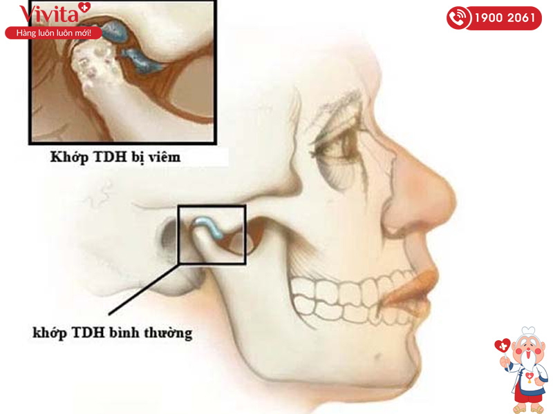 viêm khớp thái dương hàm là gì