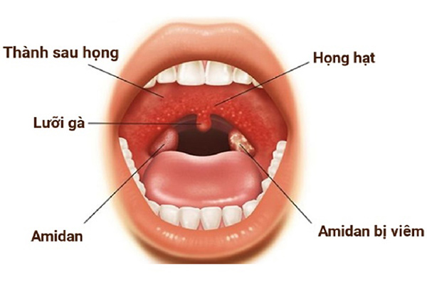 Viêm họng hạt là gì? Nguyên nhân, triệu chứng, cách chữa