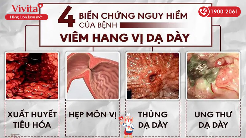 triệu chứng viêm xung huyết hanh vị dạ dày