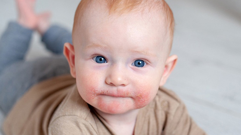 Dấu hiệu sớm và đặc trưng của chàm sữa ở trẻ là các mảng da đỏ, ngứa rát và bị nổi mụn nước