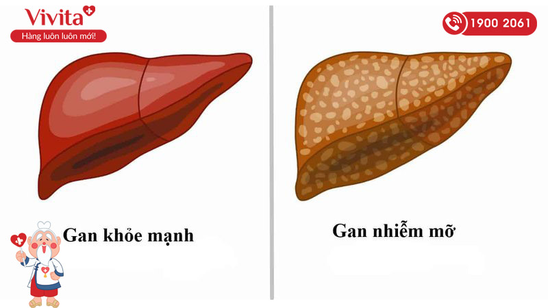 thuốc trị gan nhiễm mỡ