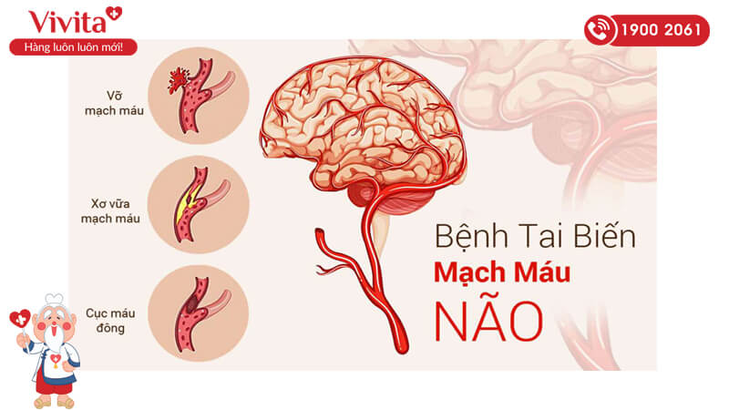 Triệu chứng của tai biến mạch máu não