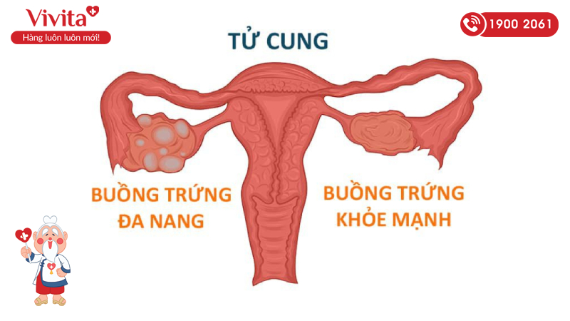 Buồng trứng đa nang có thể hạn chế khả năng sinh sản