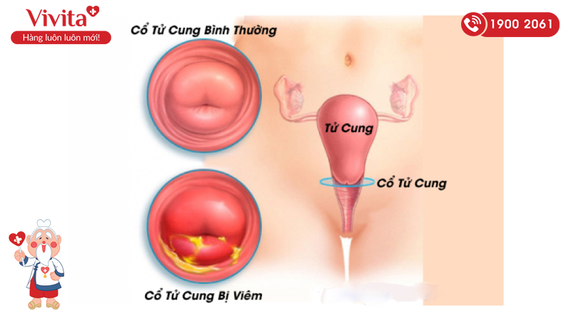 Hình ảnh so sánh cổ tử cung bình thường và cổ tử cung bị viêm