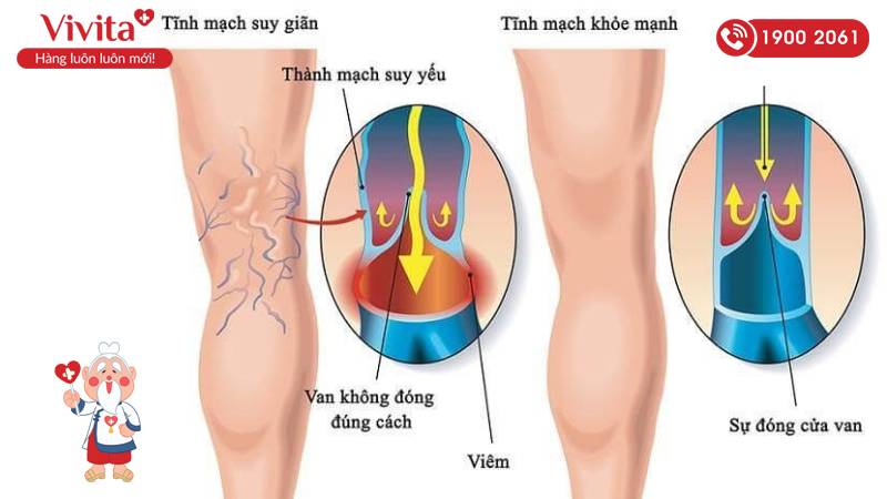 Hình ảnh so sánh tĩnh mạch bình thường và tĩnh mạch bị suy giãn