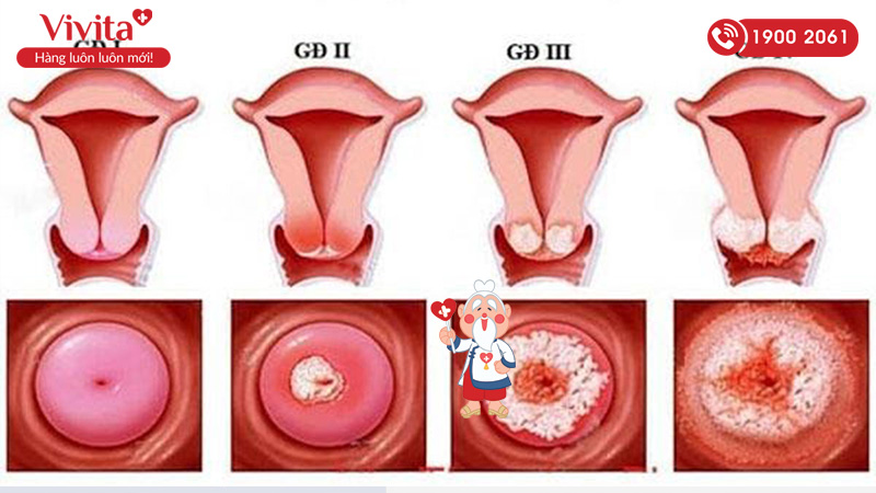 Khí hư màu nâu xuất hiện ở giai đoạn thứ nhất