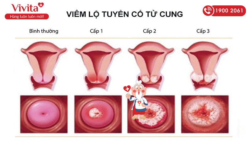 Cần thăm khám phụ khoa để phát hiện sớm bệnh này