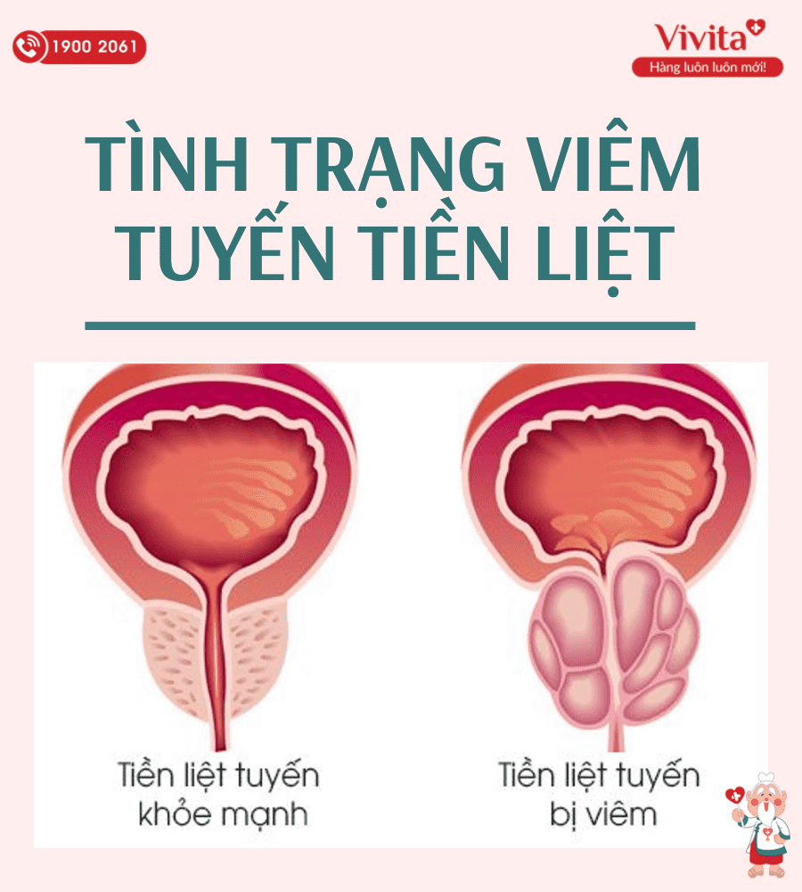 Các loại viêm tuyến tiền liệt.