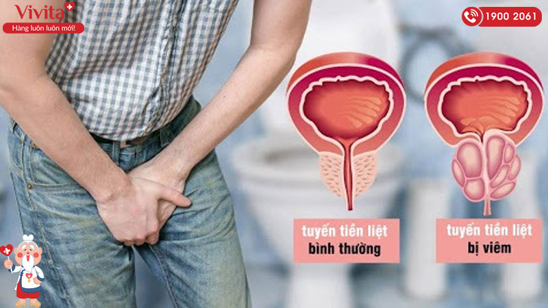 viêm tuyến tiền liệt là gì