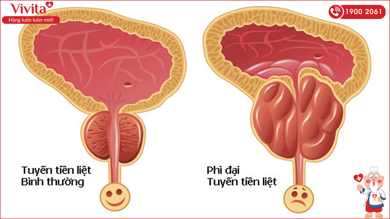 nguyên nhân phì đại tuyến tiền liệt