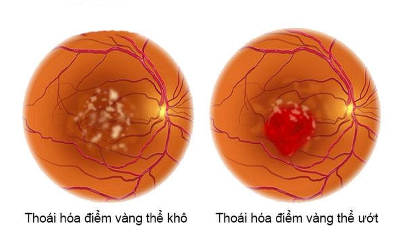 Phân Loại bệnh thoái hóa điểm vàng 