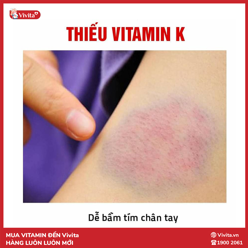 dấu hiệu thiếu vitamin k là dễ bị bầm