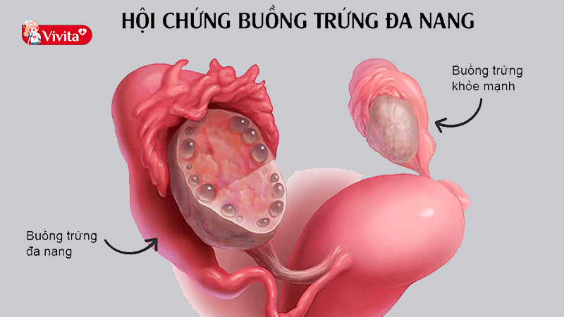 Tác dụng của vitamin E với buồng trứng và hệ sinh sản của nữ là giúp điều trị hội chứng buồng trứng đa nang