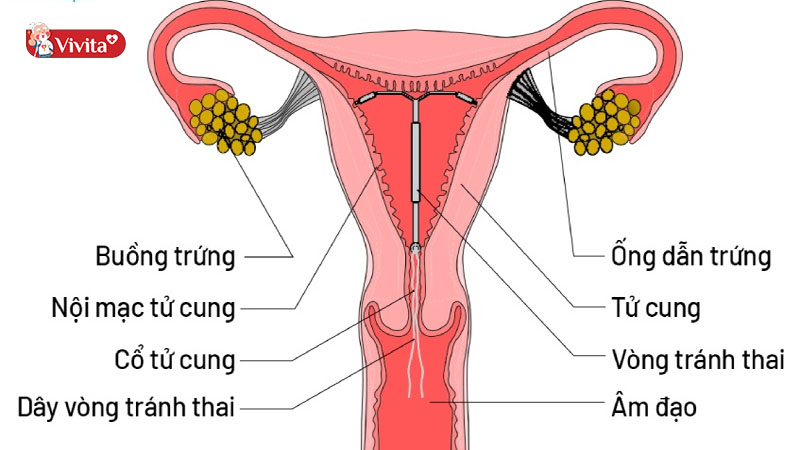 Chị em bị u xơ tử cung khi đặt vòng tránh thai cần tham khảo ý kiến bác sĩ