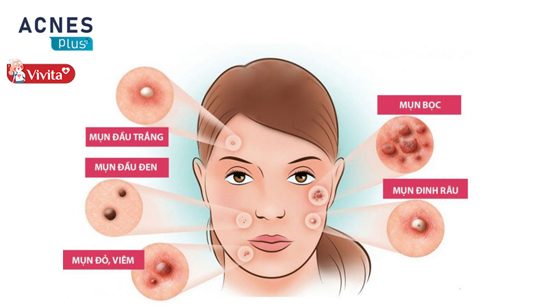 Acnes Plus mang đến công dụng hiệu quả trong việc hỗ trợ điều trị mụn, cải thiện nội tiết tố