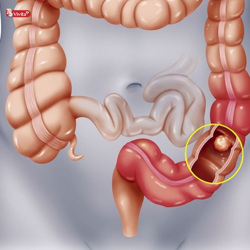 bệnh trĩ có nguy hiểm không