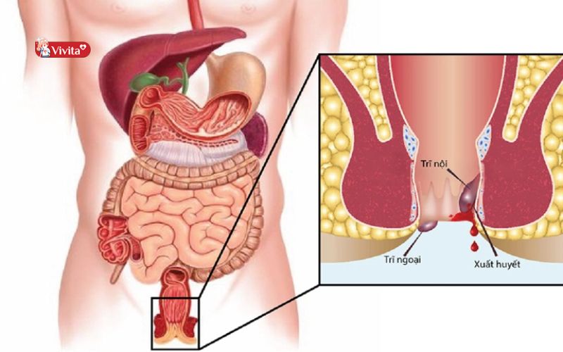 Bệnh trĩ là gì?