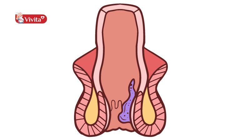 Bệnh trĩ nội cấp độ 2