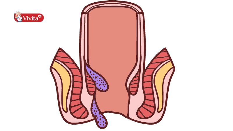 Bệnh trĩ nội cấp độ 3