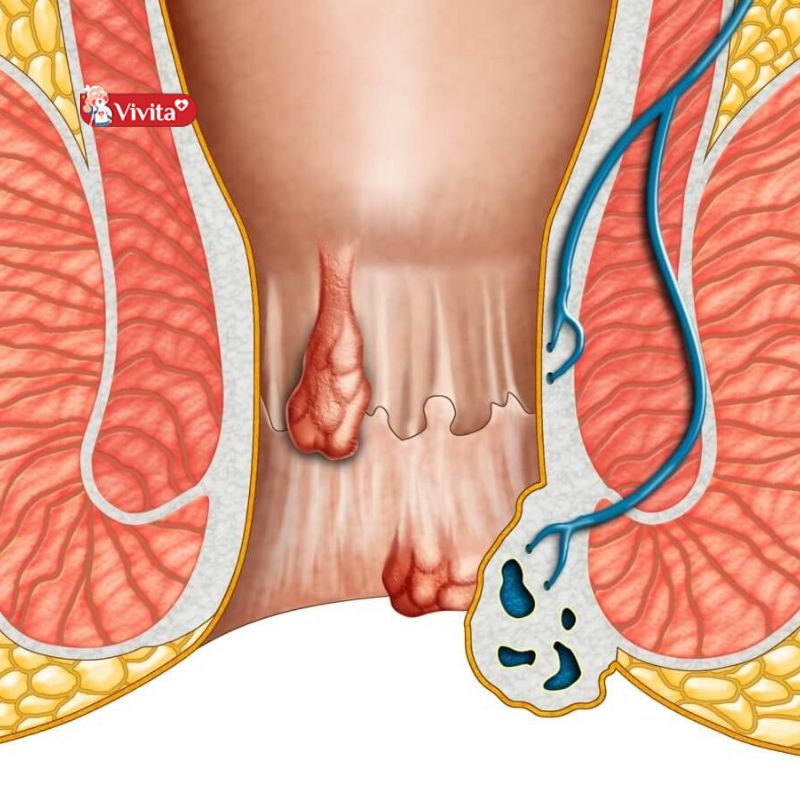 Trường hợp bệnh trĩ cần được điều trị