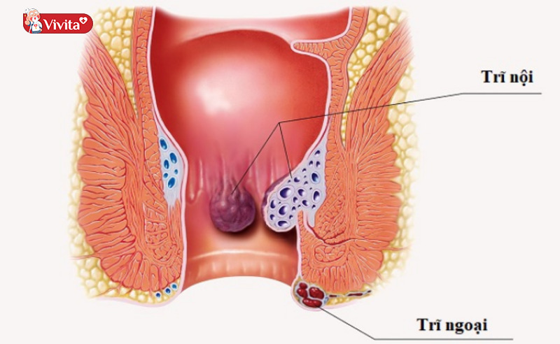 Dấu hiệu bệnh trĩ nhẹ nên biết