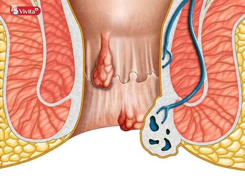 Khi nào bà bầu bị trĩ nên sinh mổ