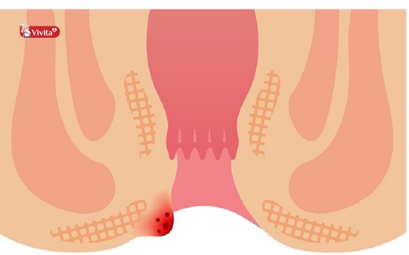 Thông tin chung về bệnh trĩ ngoại độ 1