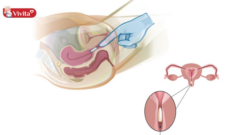 viên đặt phụ khoa trị nấm ngứa