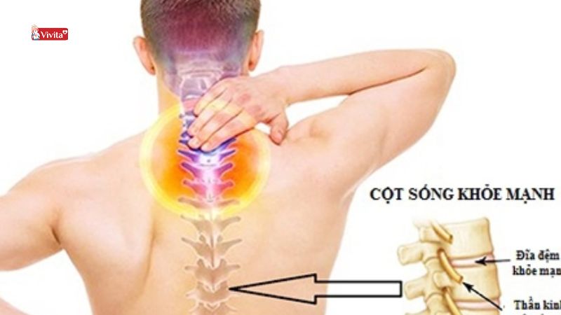 thoái hóa cột sống lưng