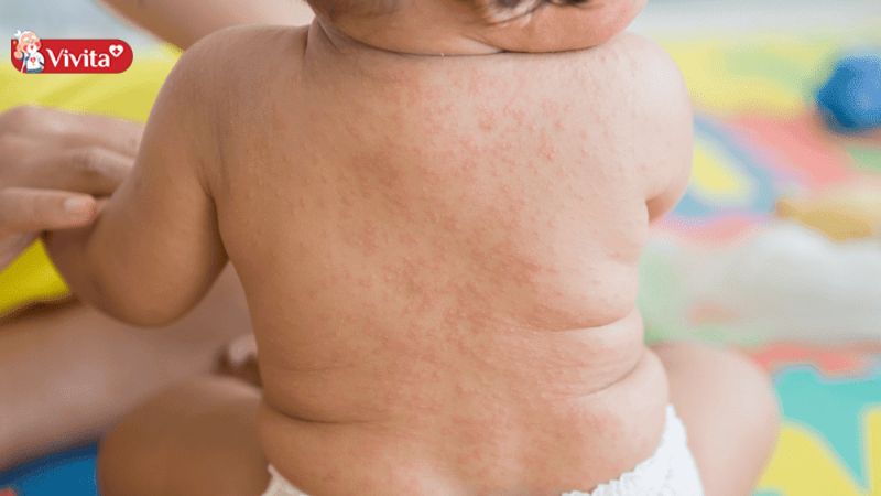 trẻ bị phát ban sau sốt cần kiêng gì